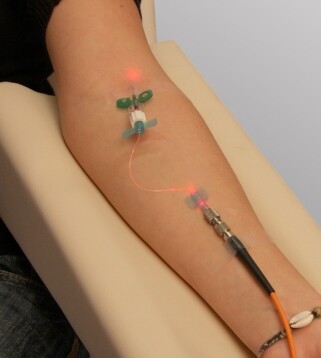 Red laser light applied through fiber-optic probes during an in-clinic photodynamic therapy session.